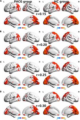 Machine learning analysis reveals abnormal functional network hubs in the primary angle-closure glaucoma patients